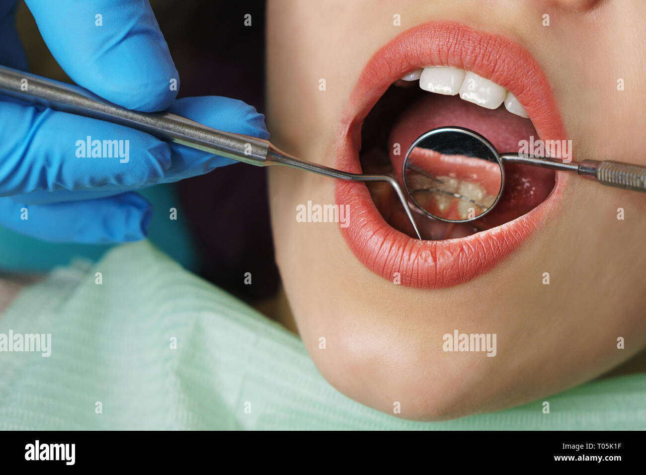 Dentist examines rear surface of woman's teeth. Young girl with open