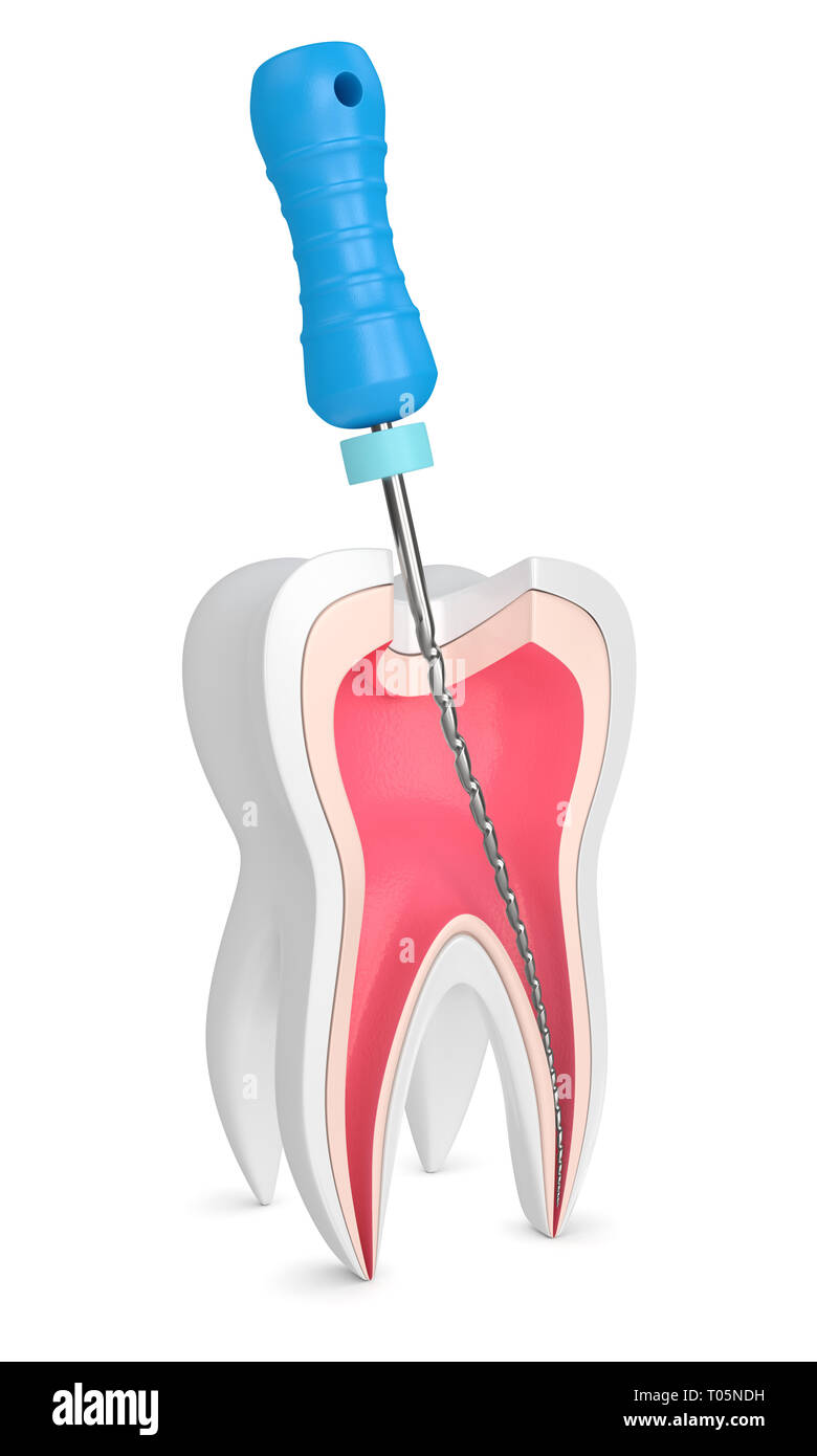 3d render of tooth with endodontic file over white background. Root