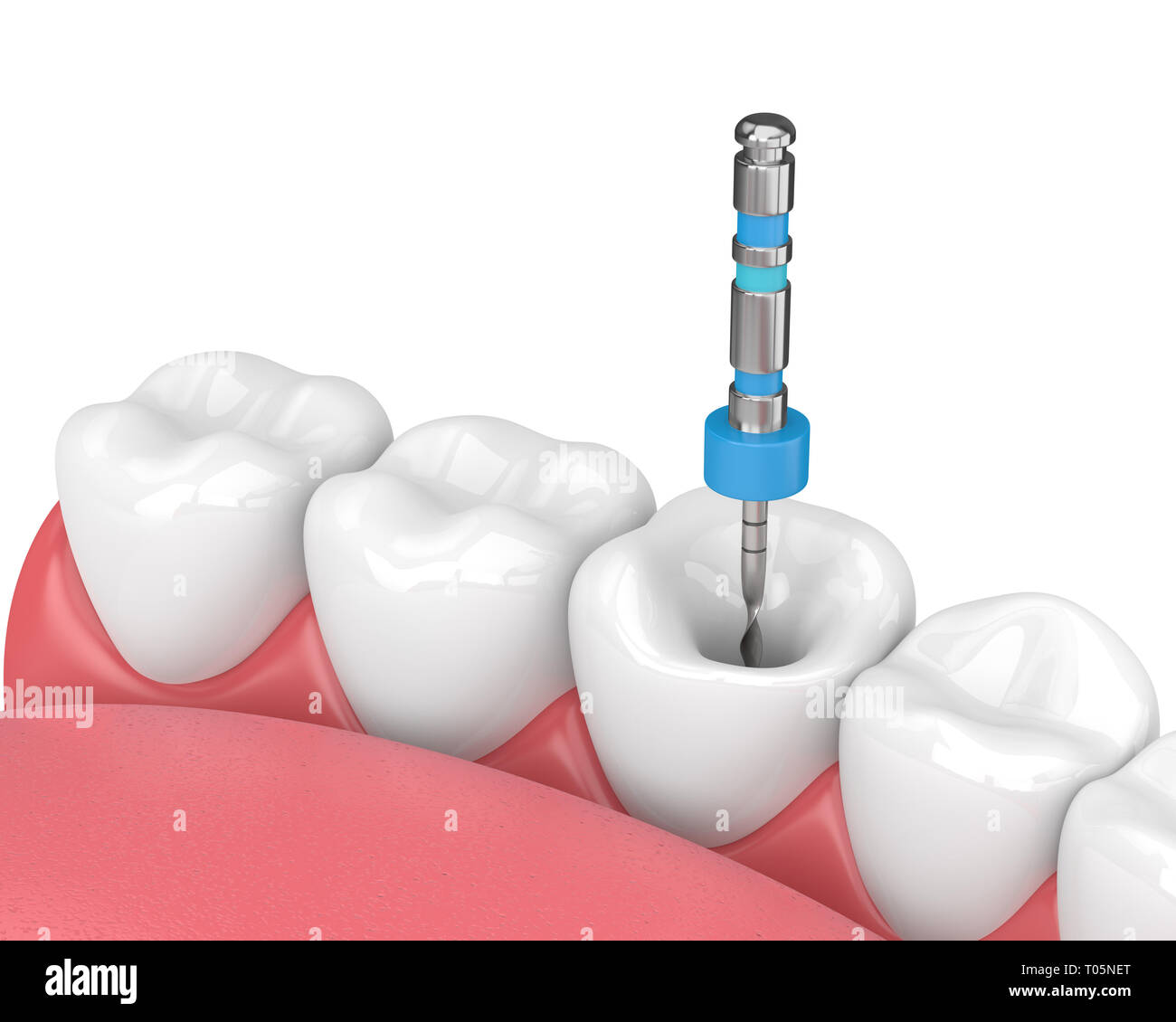 3d render of tooth with endodontic file in jaw over white background