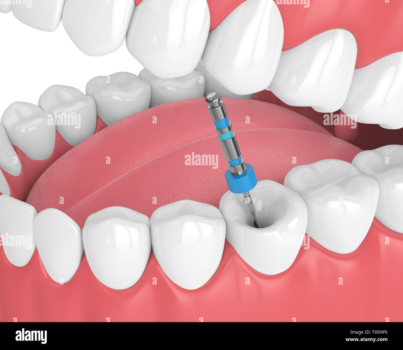 3d render of tooth with endodontic file in jaw over white background