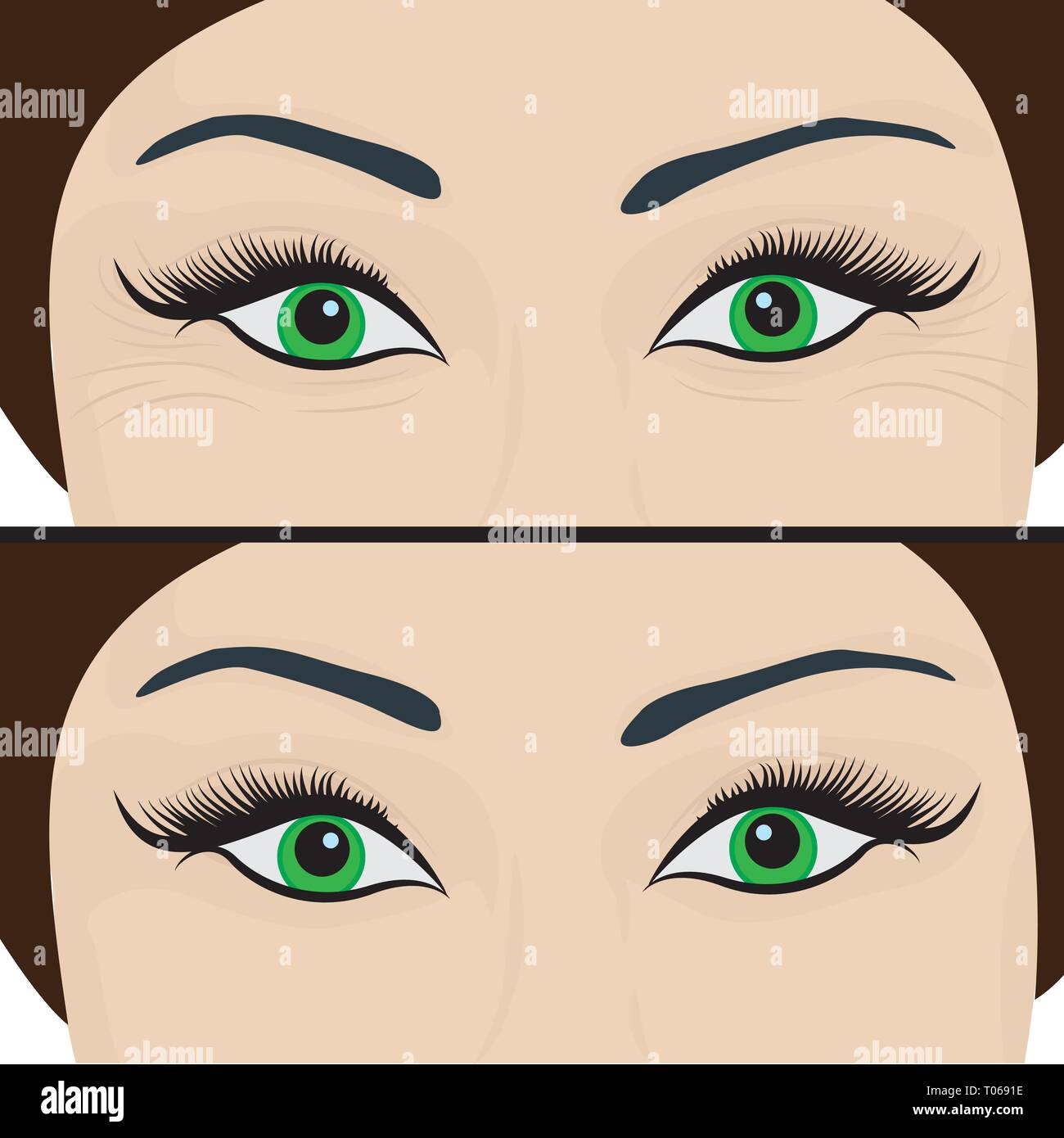 Wrinkles and fine lines under eyes to remove. Before and After. Eyes