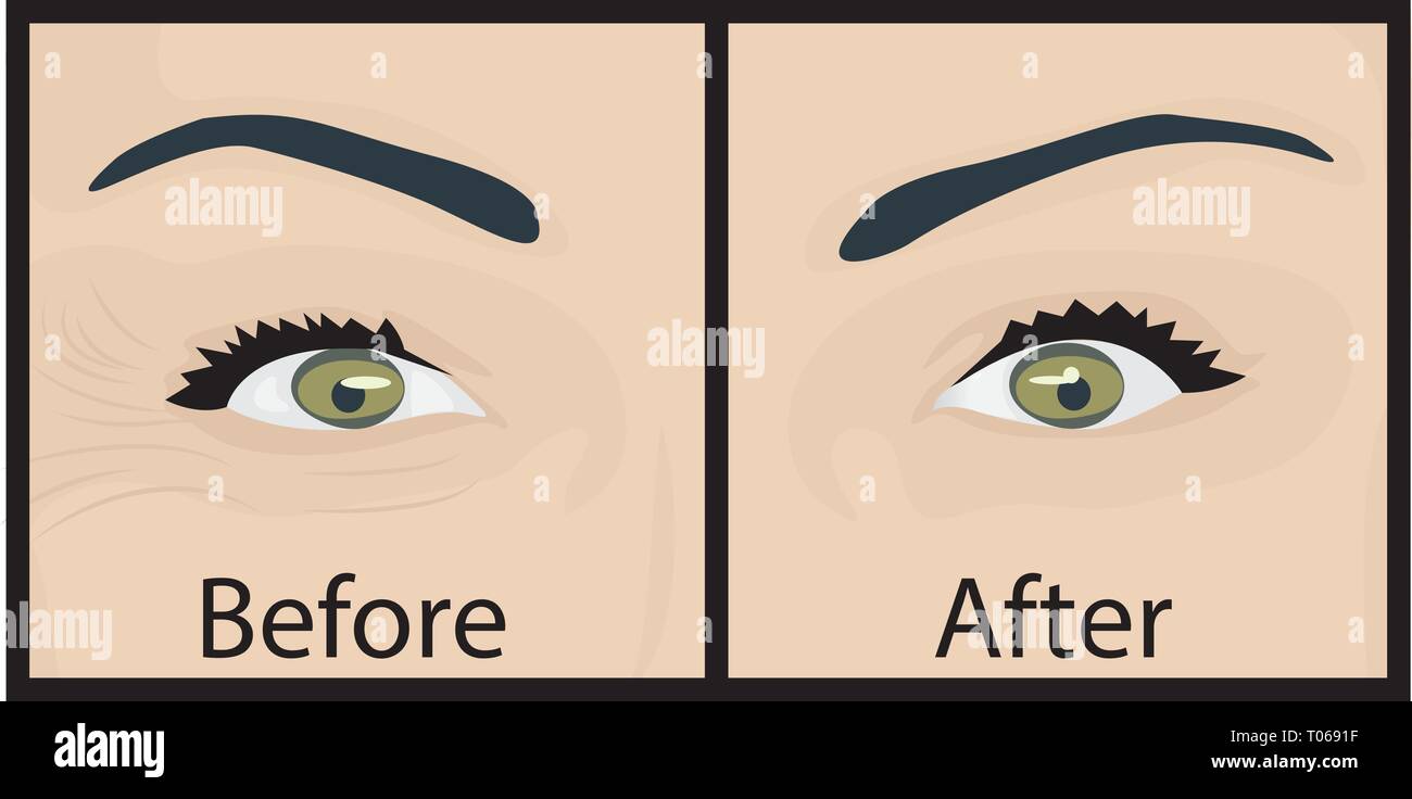 Wrinkles and fine lines under eyes to remove. Before and After. Eyes