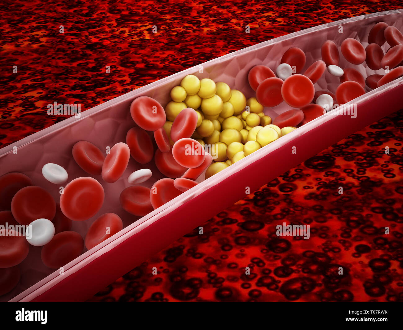 Fat cells blocking the blood flow inside human vein. 3D illustration. Stock Photo