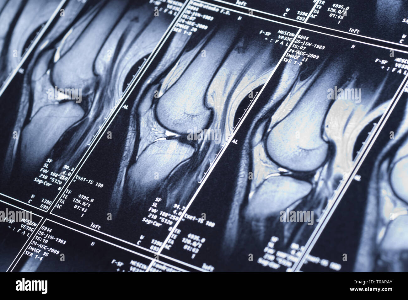 My knee MRI - sport trauma, damage of cross-shaped ligaments Stock Photo