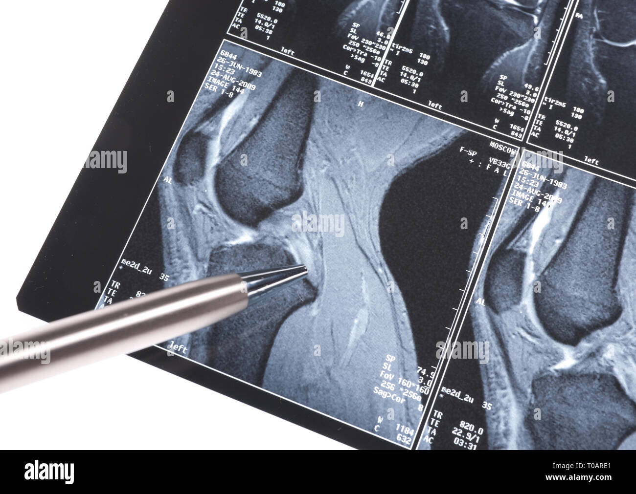 MRI -  damage of cross-shaped ligaments Stock Photo