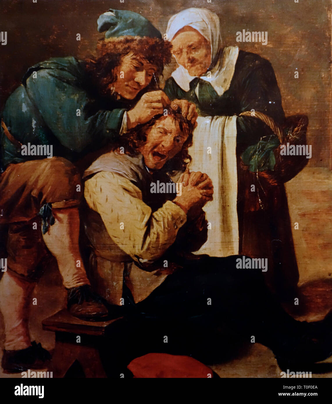 Painting showing trepanation / trepanning, surgical intervention in which a hole is drilled or scraped into the human skull Stock Photo