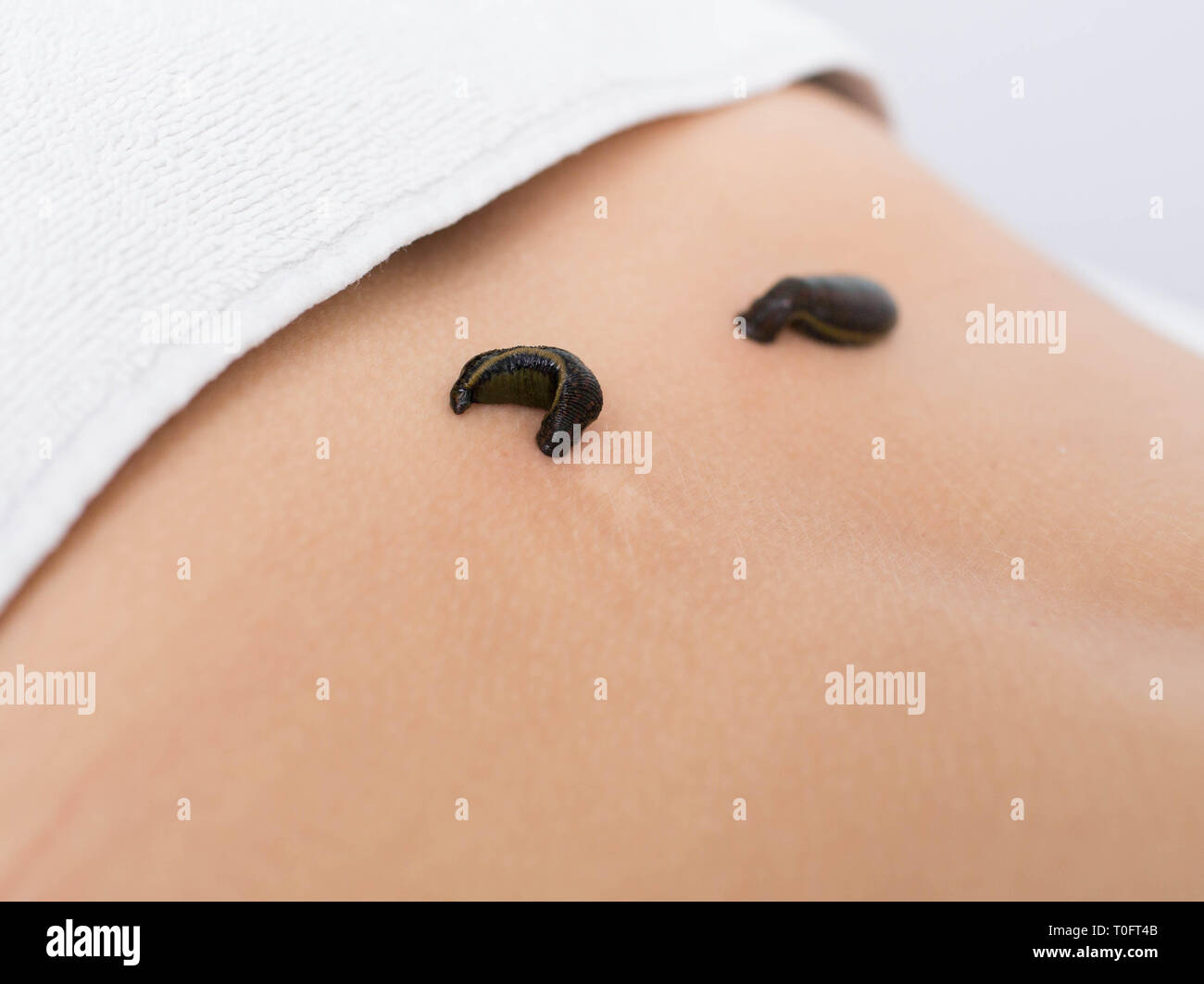 patient during leech therapy, alternative Hirudotherapy, blood purification Stock Photo
