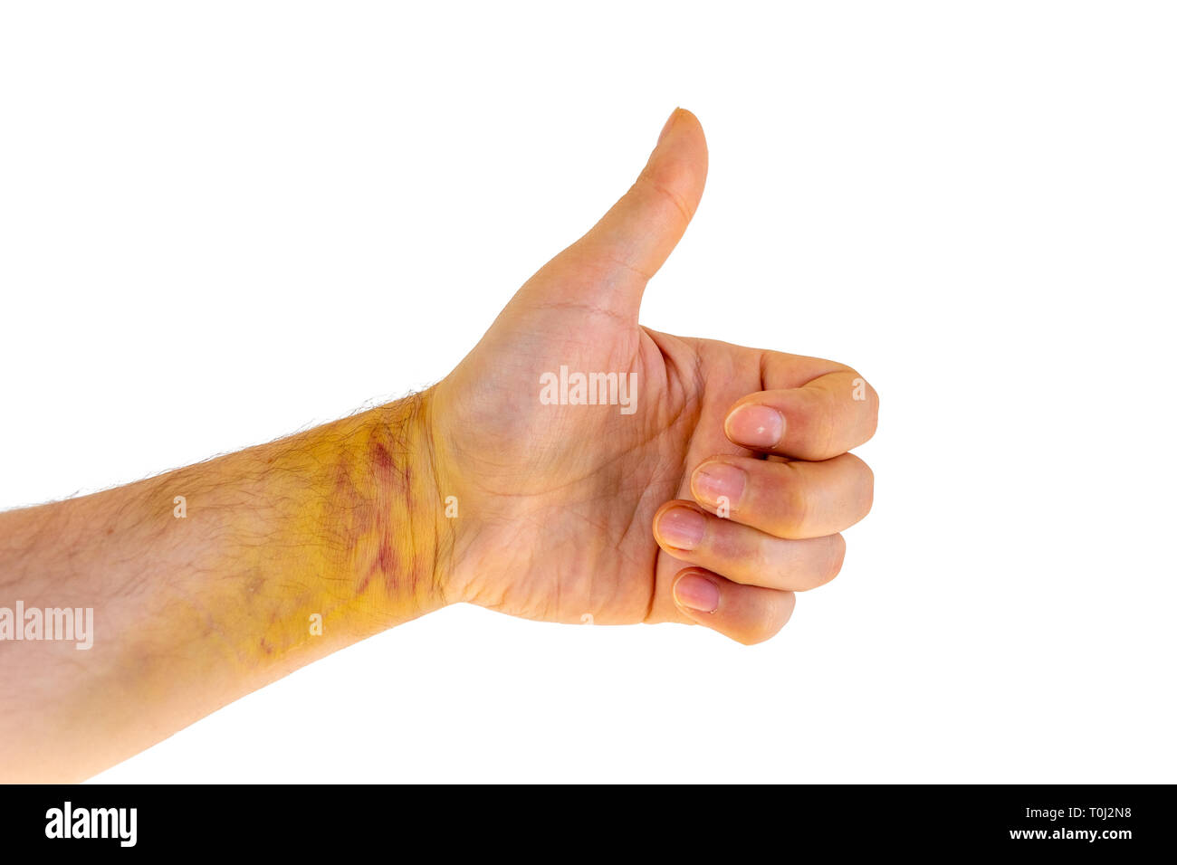 Broken hand in cast stock photo. Image of accident, isolated - 123137612