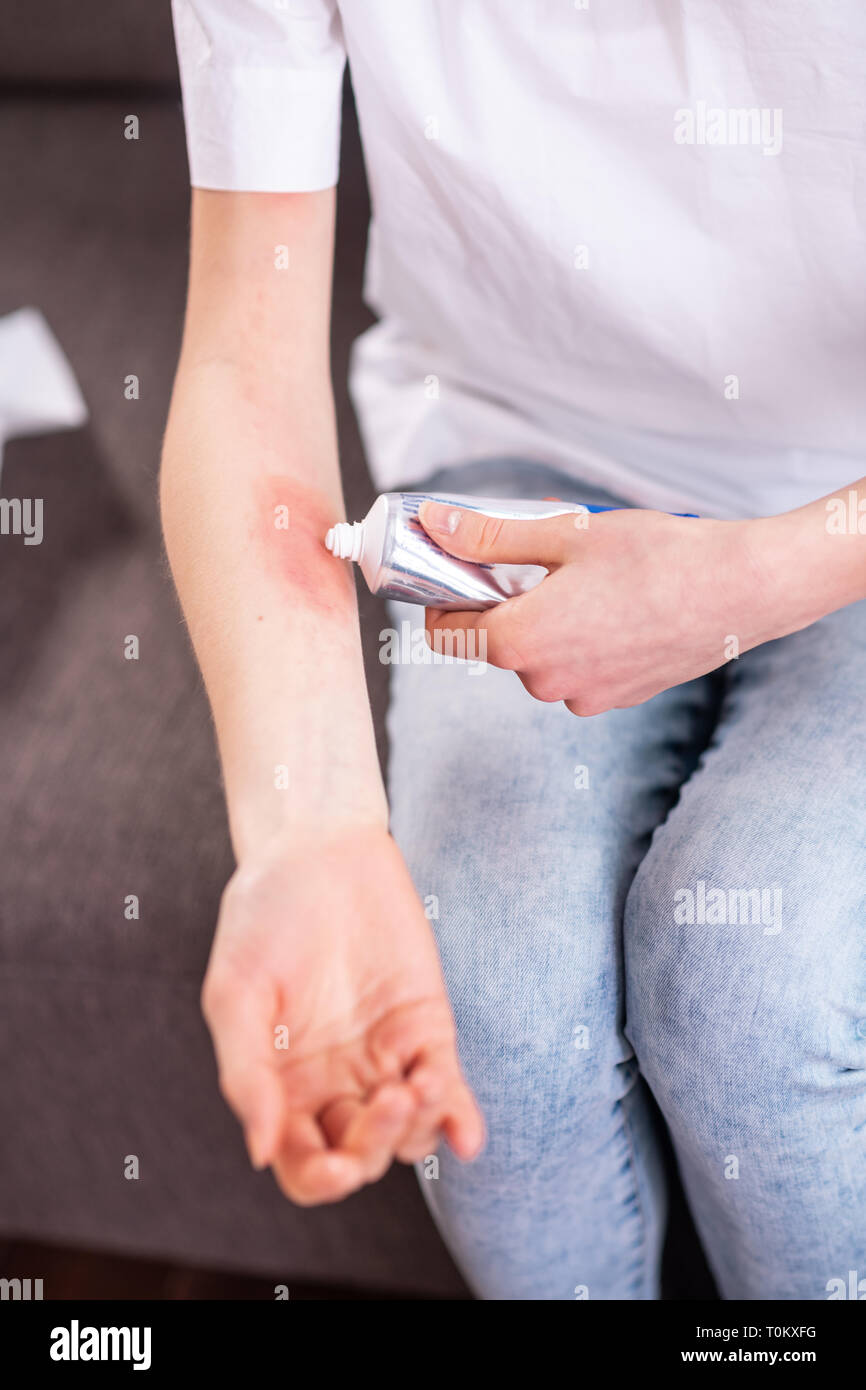 Skin rash cream hi-res stock photography and images - Alamy