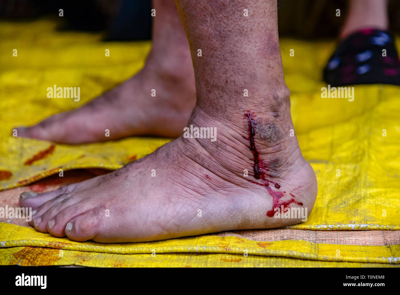 Impure blood seen coming out of a Kashmiri patient's foot during the leech treatment. A traditional health worker uses leeches to suck impure blood as part of a treatment at Hazratbal on the banks of the Dal Lake on the outskirts of Srinagar Summer capital of Indian administered Kashmir. Every year traditional health workers in Kashmir use leeches to treat people for itchy, painful lumps that develop on the skin called chilblains acquired during winter. Thousands of patients suffering from various skin problems receives leech treatment at Hazratbal in Srinagar. Stock Photo
