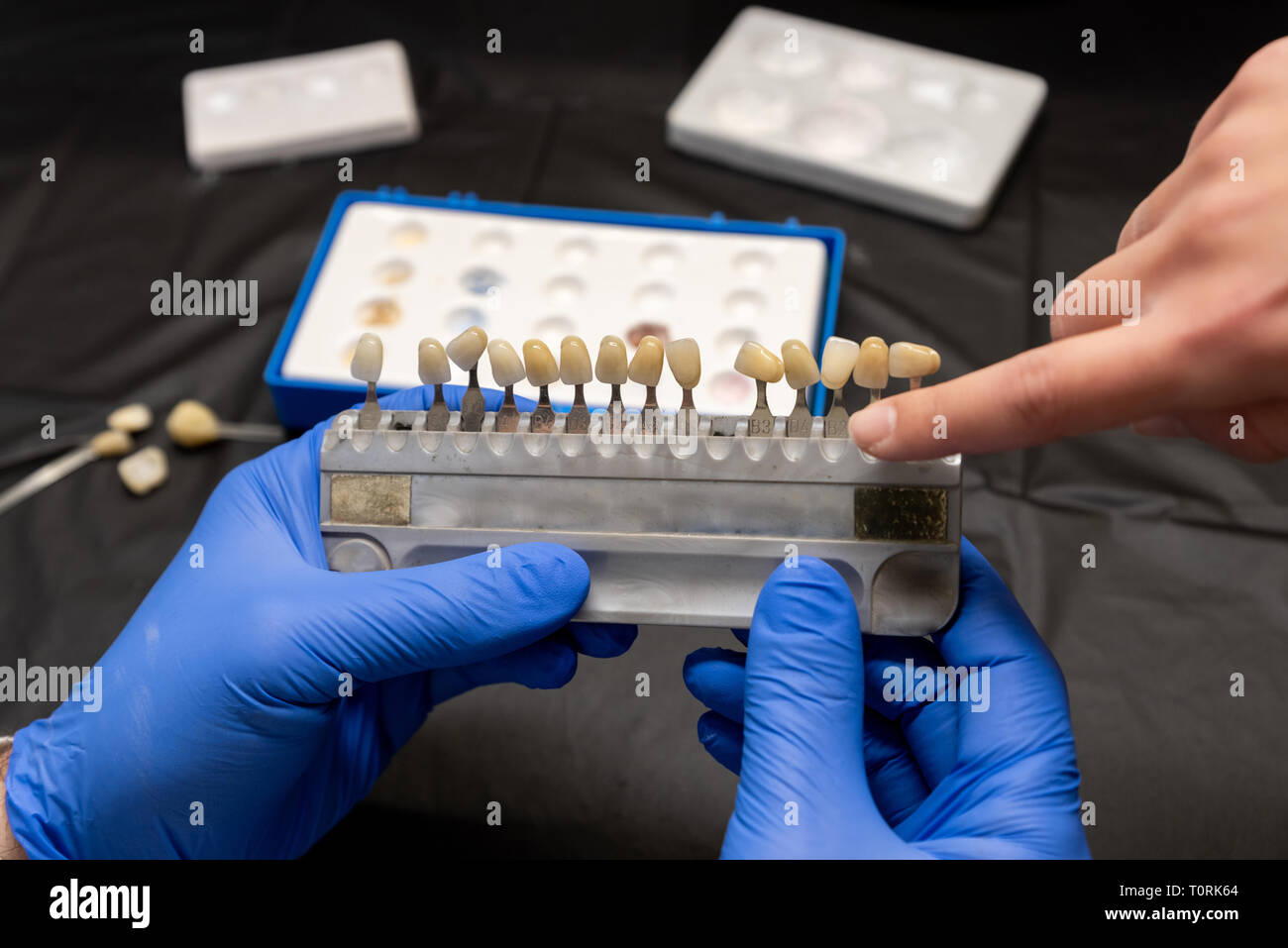 Using shade guide to choose veneer of tooth crown Stock Photo Alamy