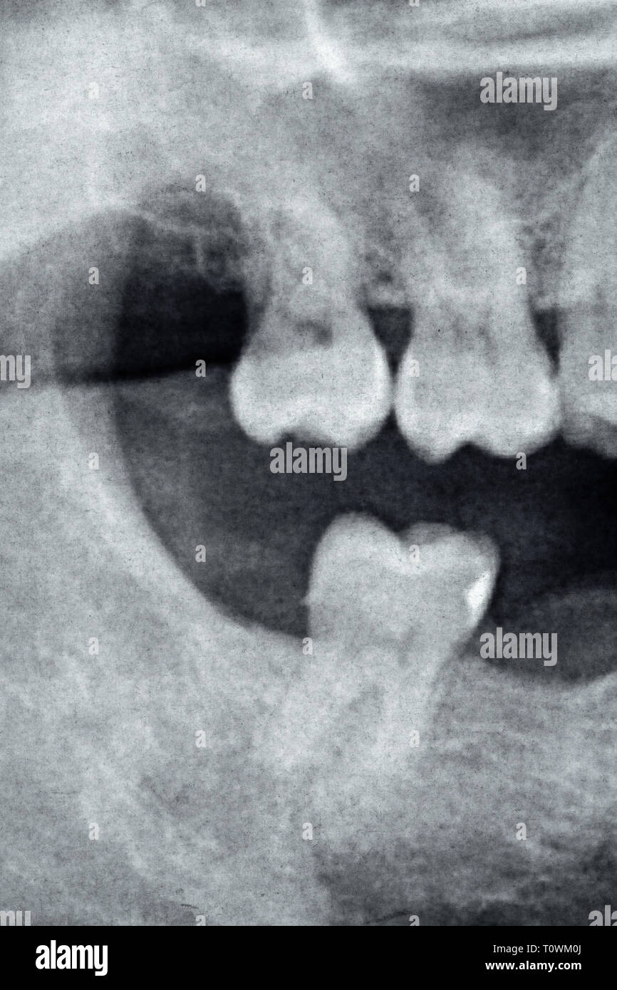 Dental X-Ray of the right side of back tooth Stock Photo - Alamy