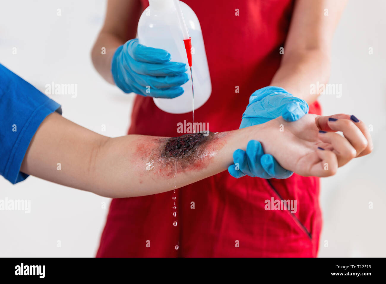 First aid training. Burn injury. First aid course Stock Photo Alamy