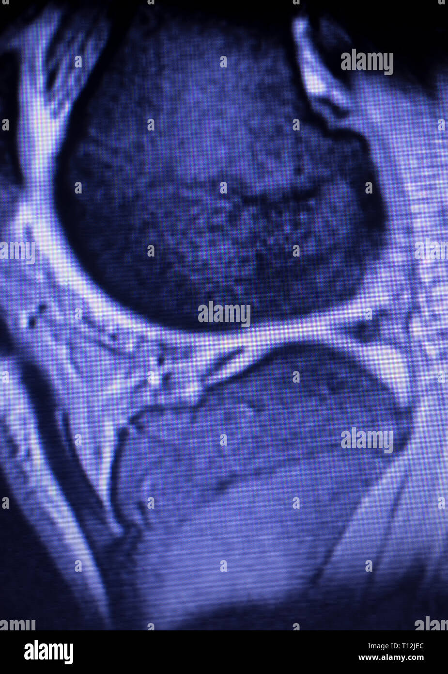 Magnetic resonance imaging MRI knee posterior horn medial meniscus tear ...