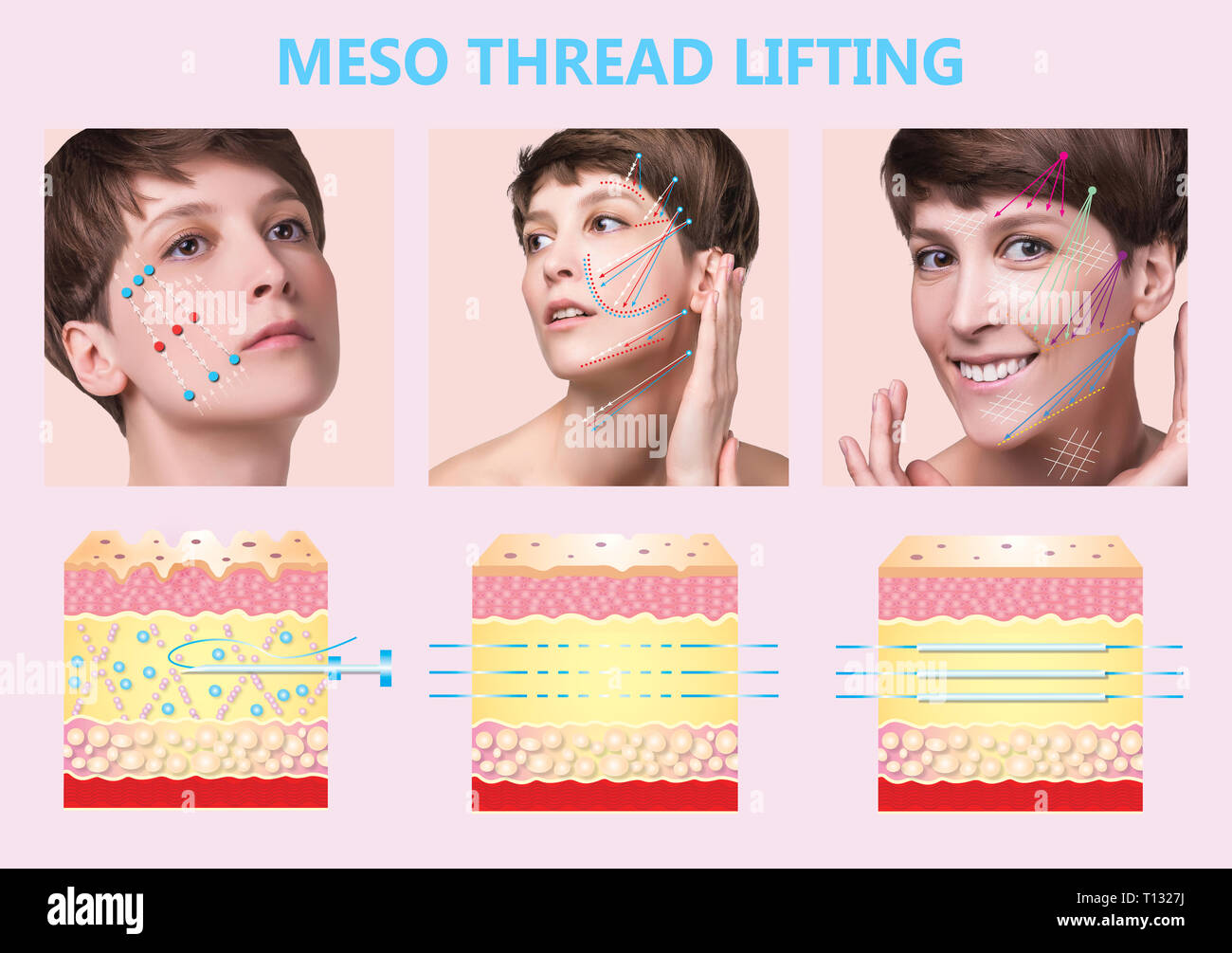 Meso thread Lift. Young female with clean fresh skin. Beautiful woman