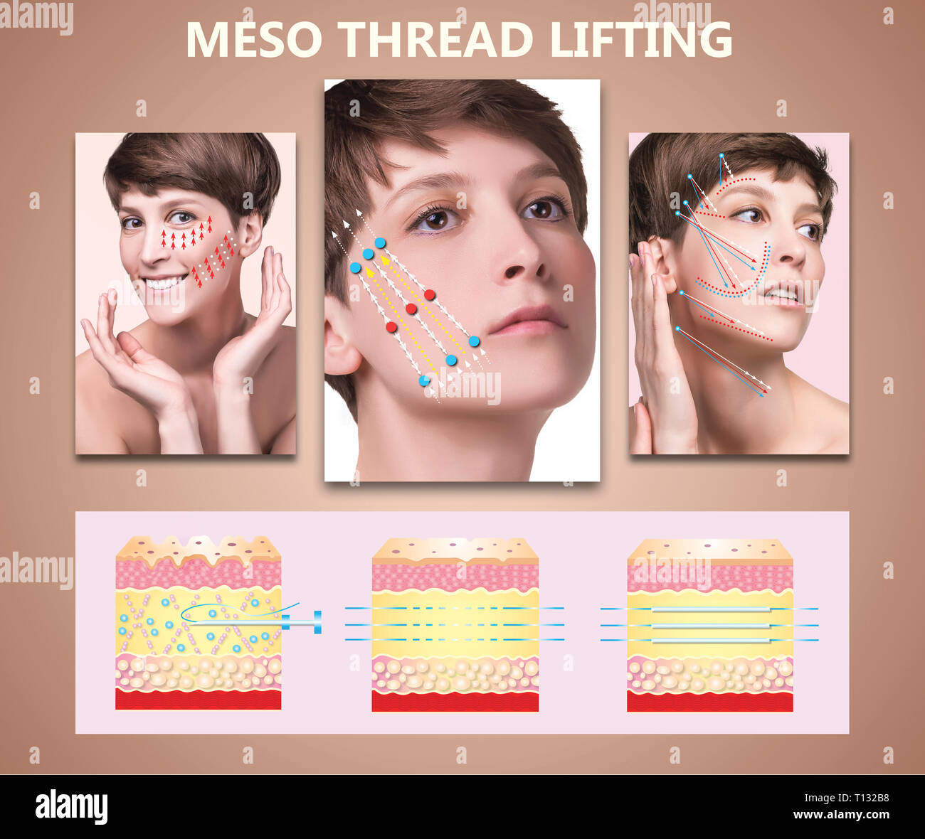 Meso thread Lift. Young female with clean fresh skin. Beautiful woman. face and neck Stock Photo