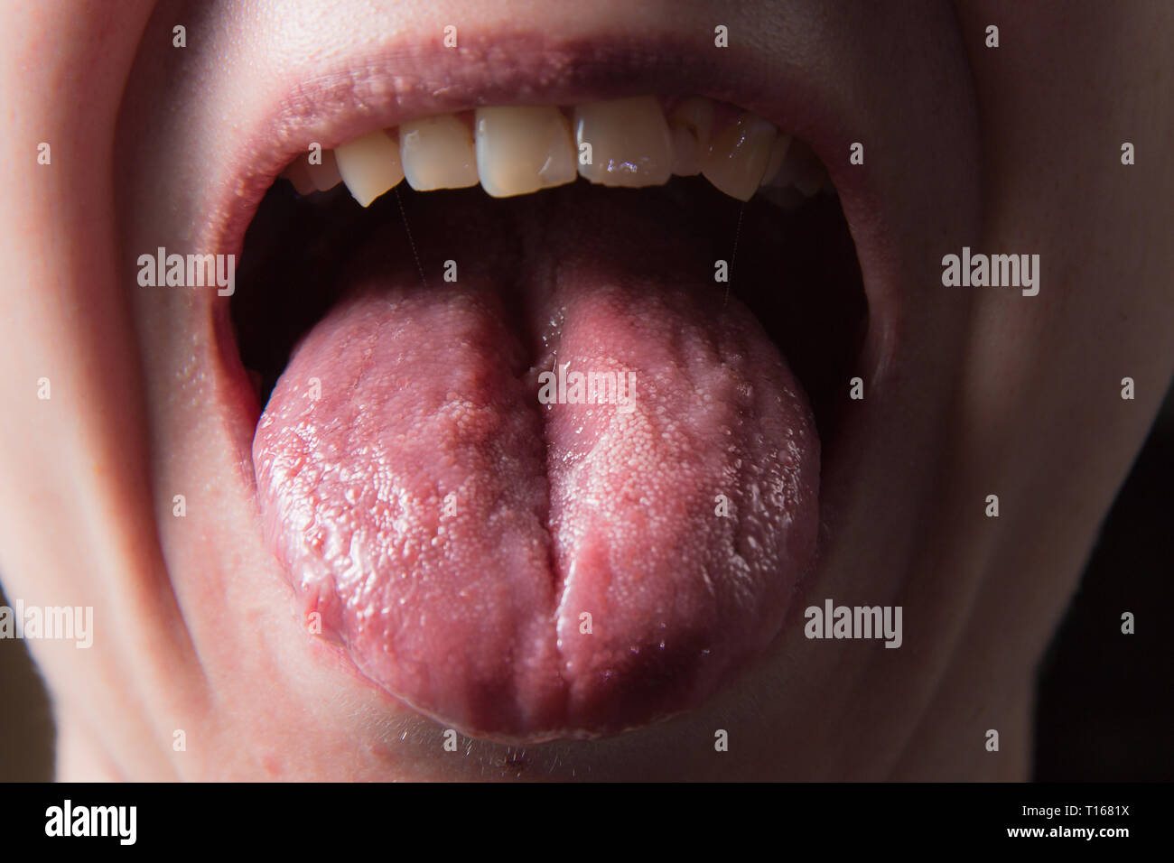 Male shows overgrowth candidiasis on his tongue Stock Photo