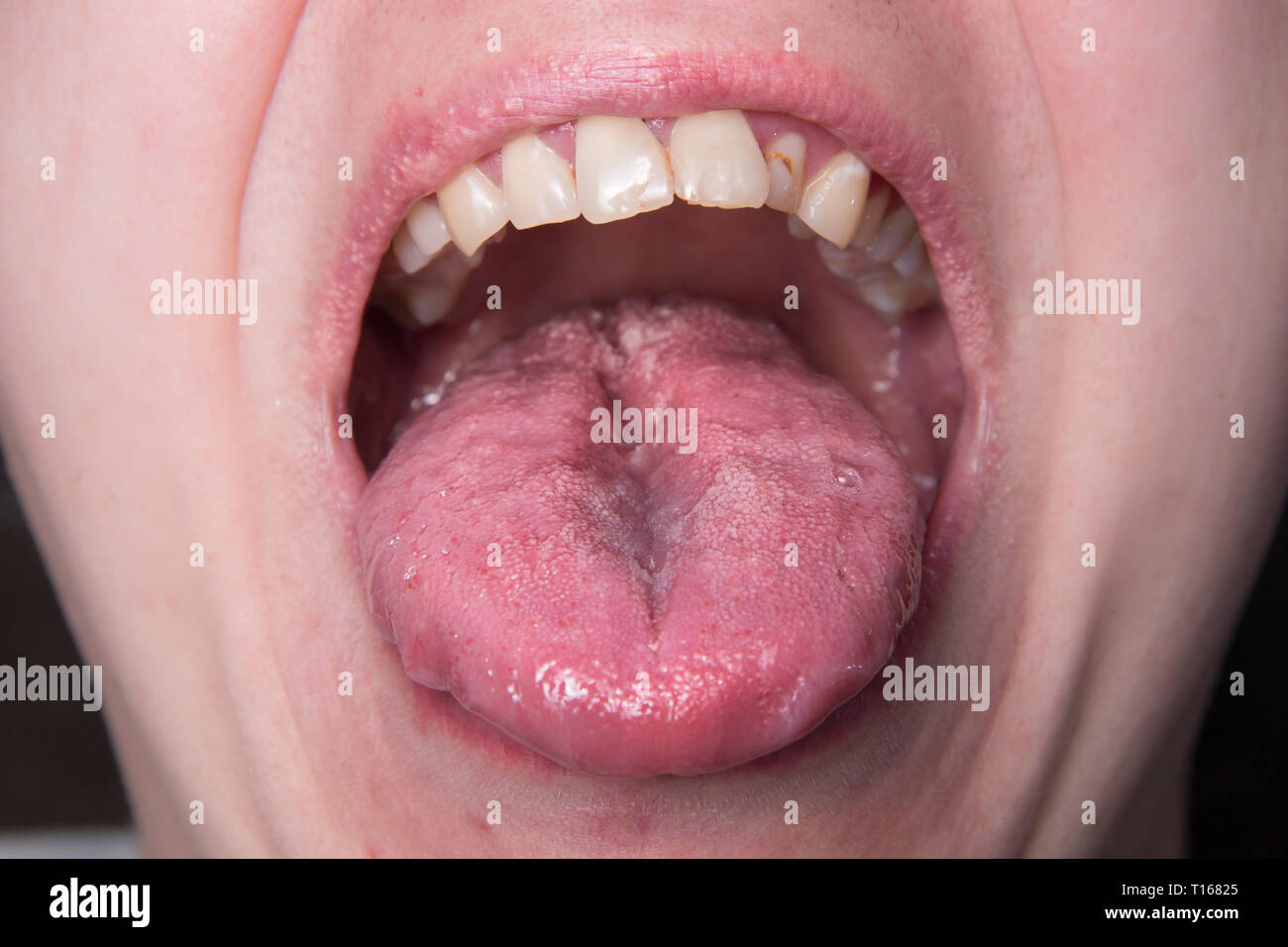 Male shows overgrowth candidiasis on his tongue Stock Photo