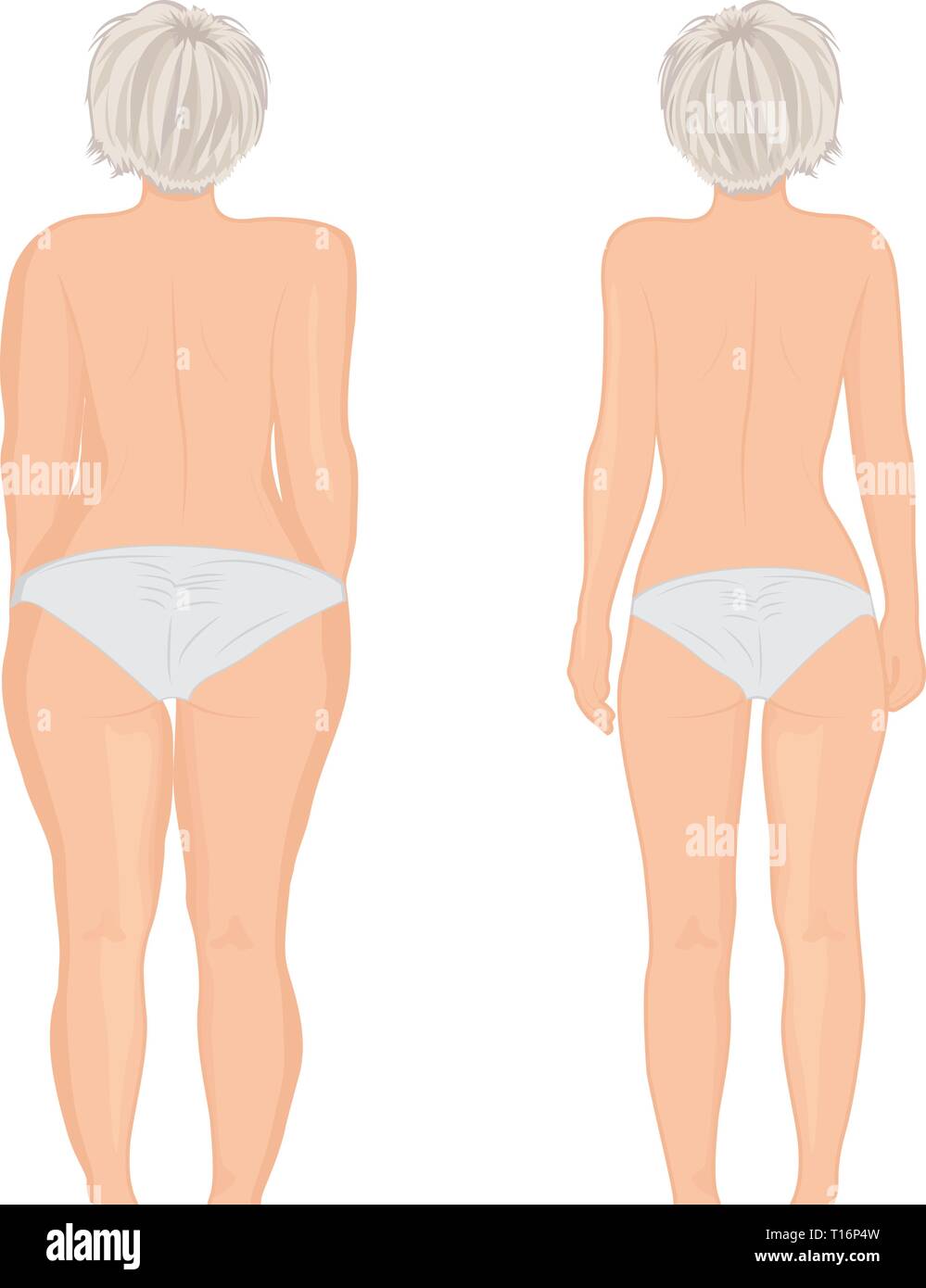 Fat and slim girl's back. Fat thig. Liposuction. Before and after. Woman body correction vector illustration Stock Vector