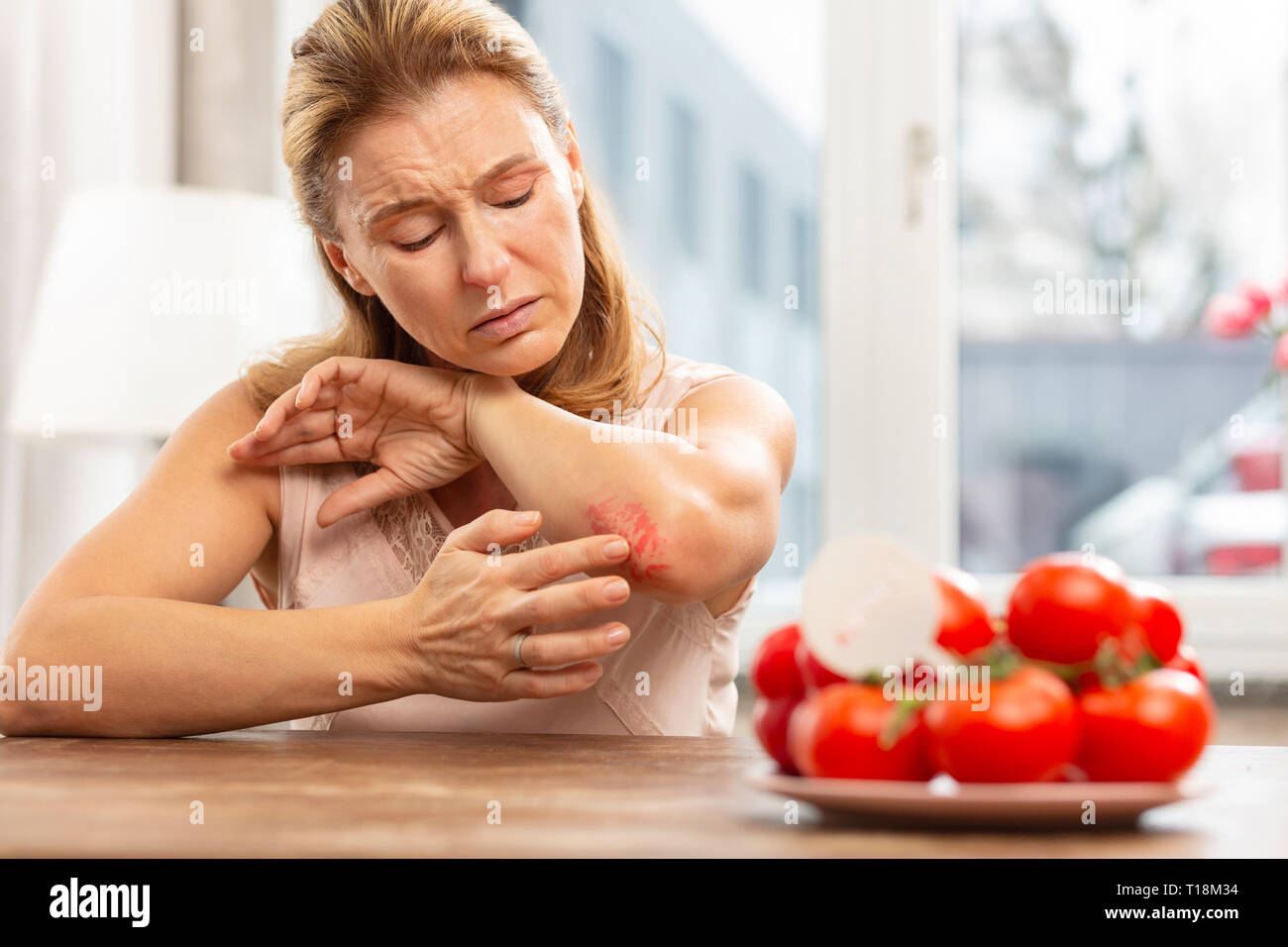 Woman having rash and scratches on elbow because of allergy Stock Photo
