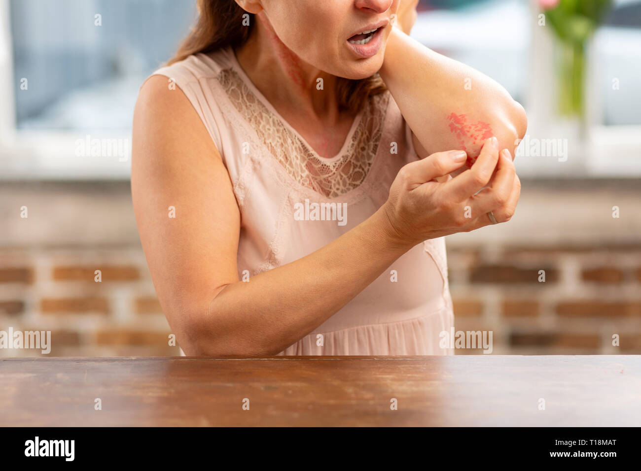 Mature housewife standing near the table and having rash on elbow Stock Photo