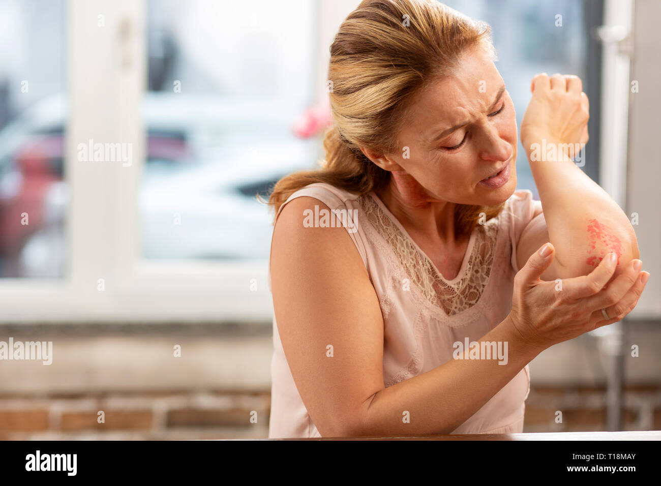 Mature woman with strong allergy noticing rash on elbow Stock Photo