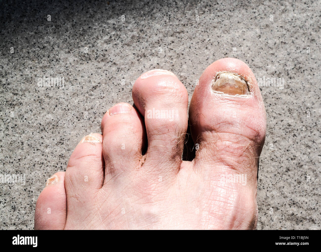 detail view of ugly male feet and toes affected by toe nail fungus and arhtritic hammertoes Stock Photo