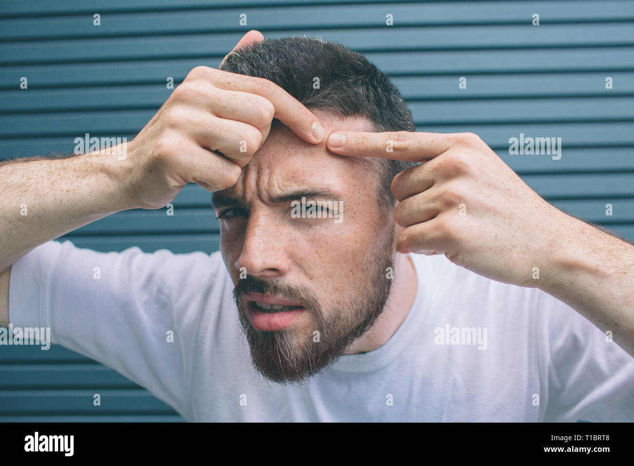 Young man is squeezing pimple on face. H is looking on camera. Isolated on striped and blue background. Stock Photo