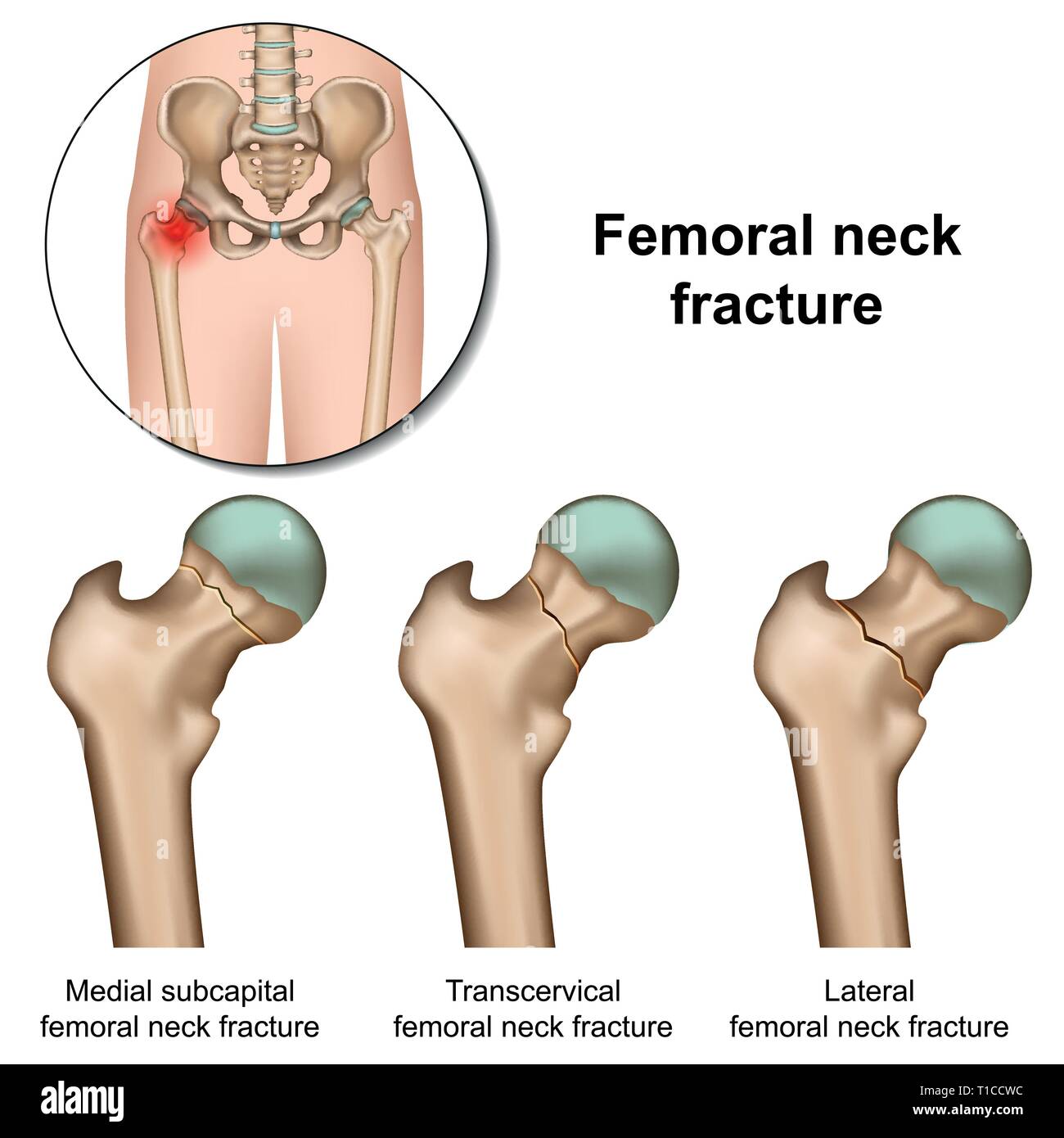 Femoral neck fractures medical vector illustration on white background Stock Vector