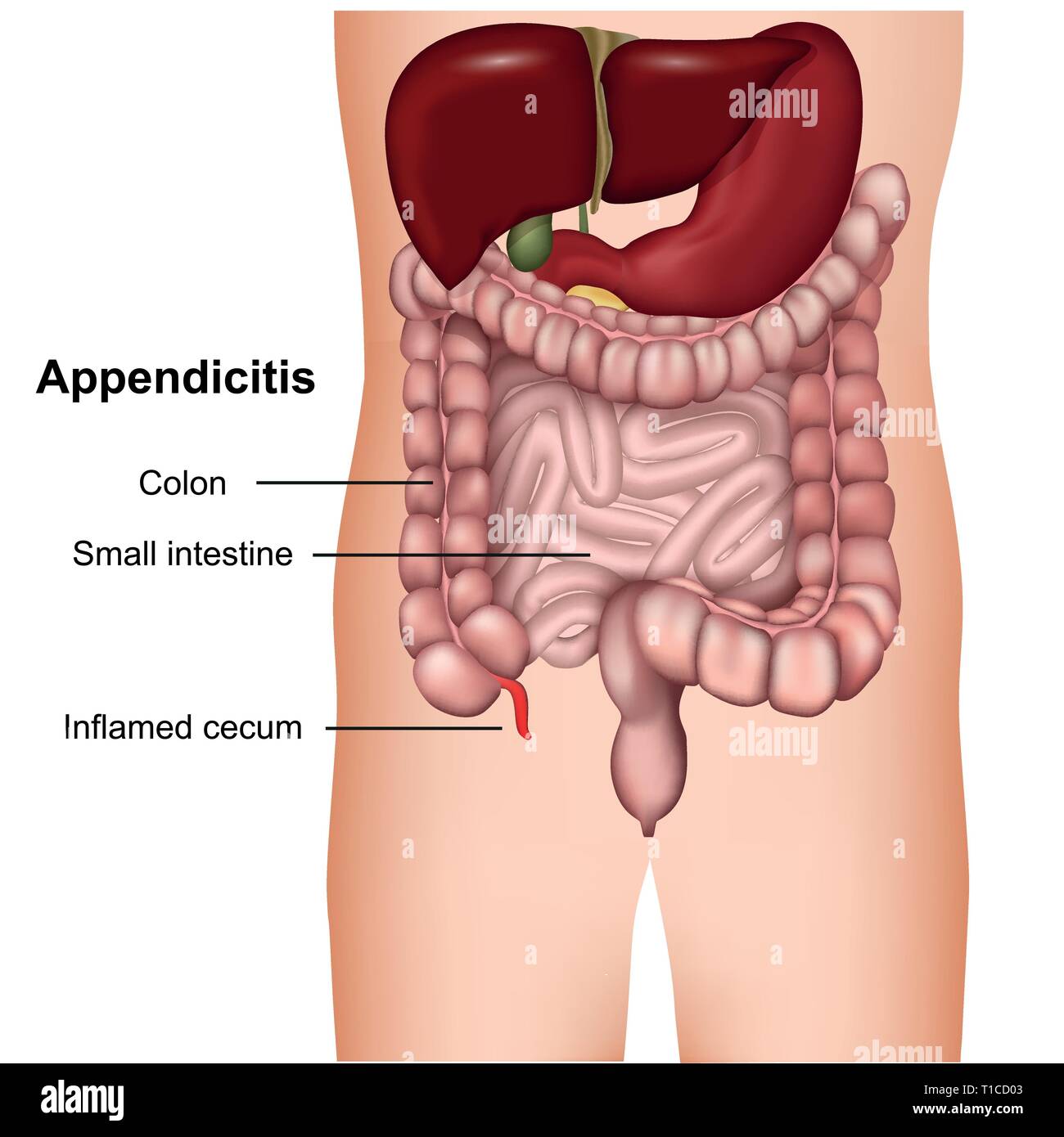 appendicitis 3d medical vector illustration isolated on white background Stock Vector