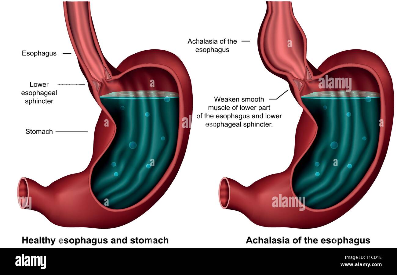 esophageal achalasia 3d medical vector illustration on white background Stock Vector