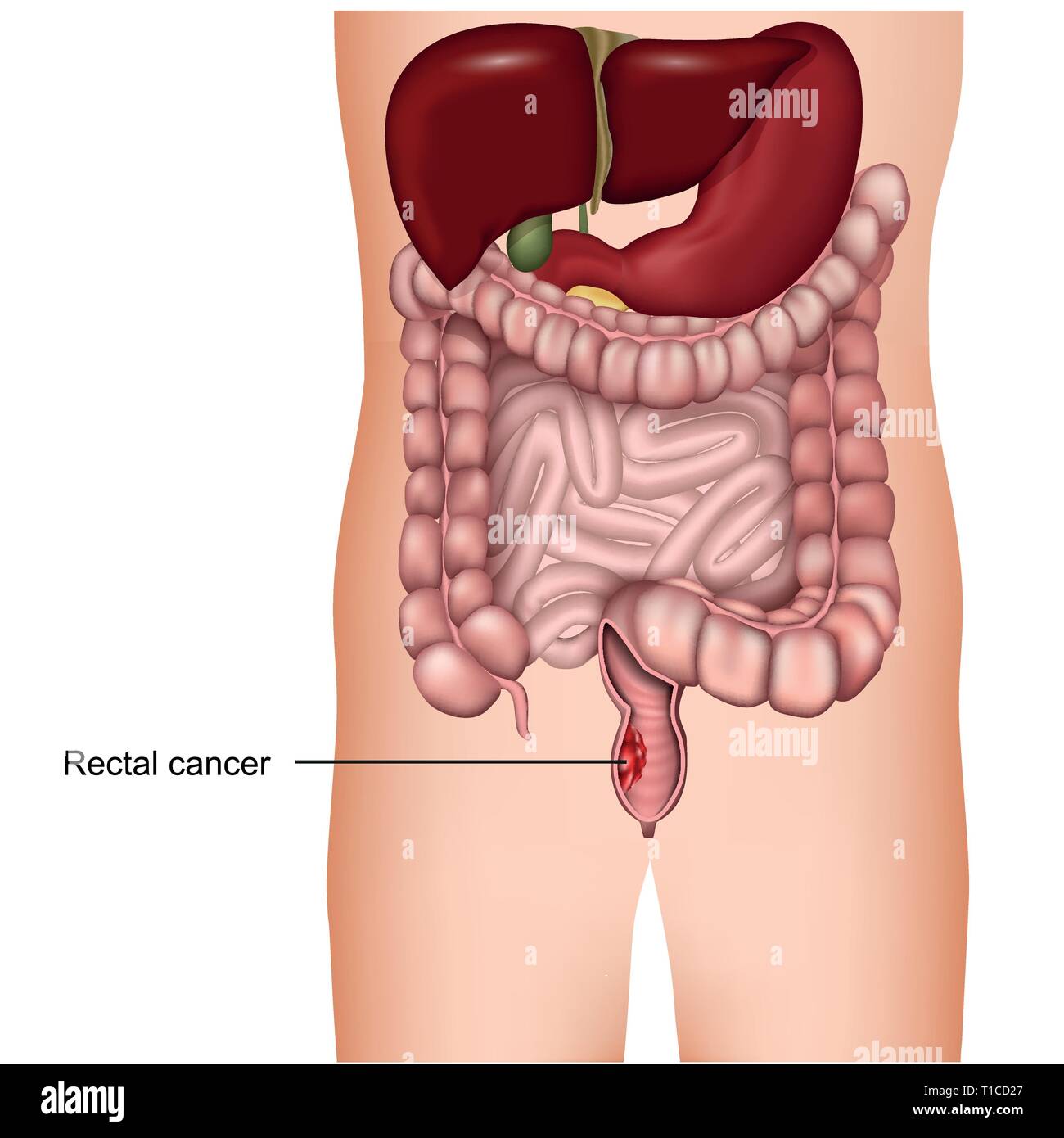 rectal cancer medical 3d vector illustration on white background, colorectal cancer Stock Vector