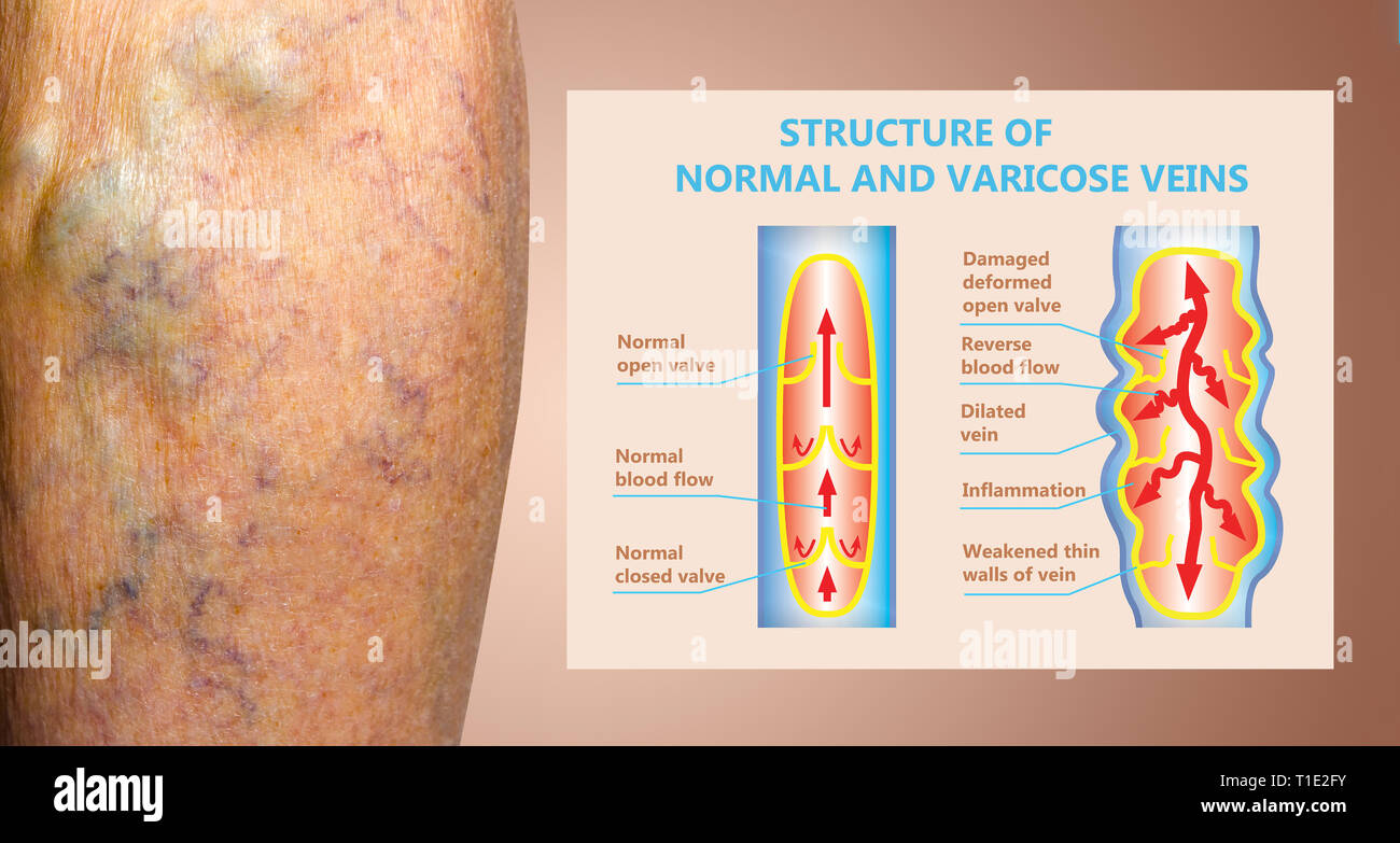 Varicose veins on a female senior legs. The structure of normal and