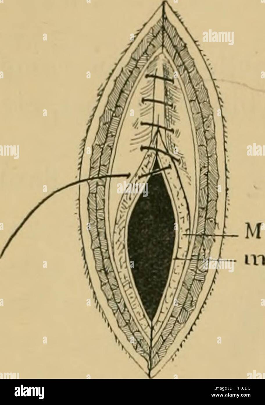 Macerated wound hires stock photography and images Alamy