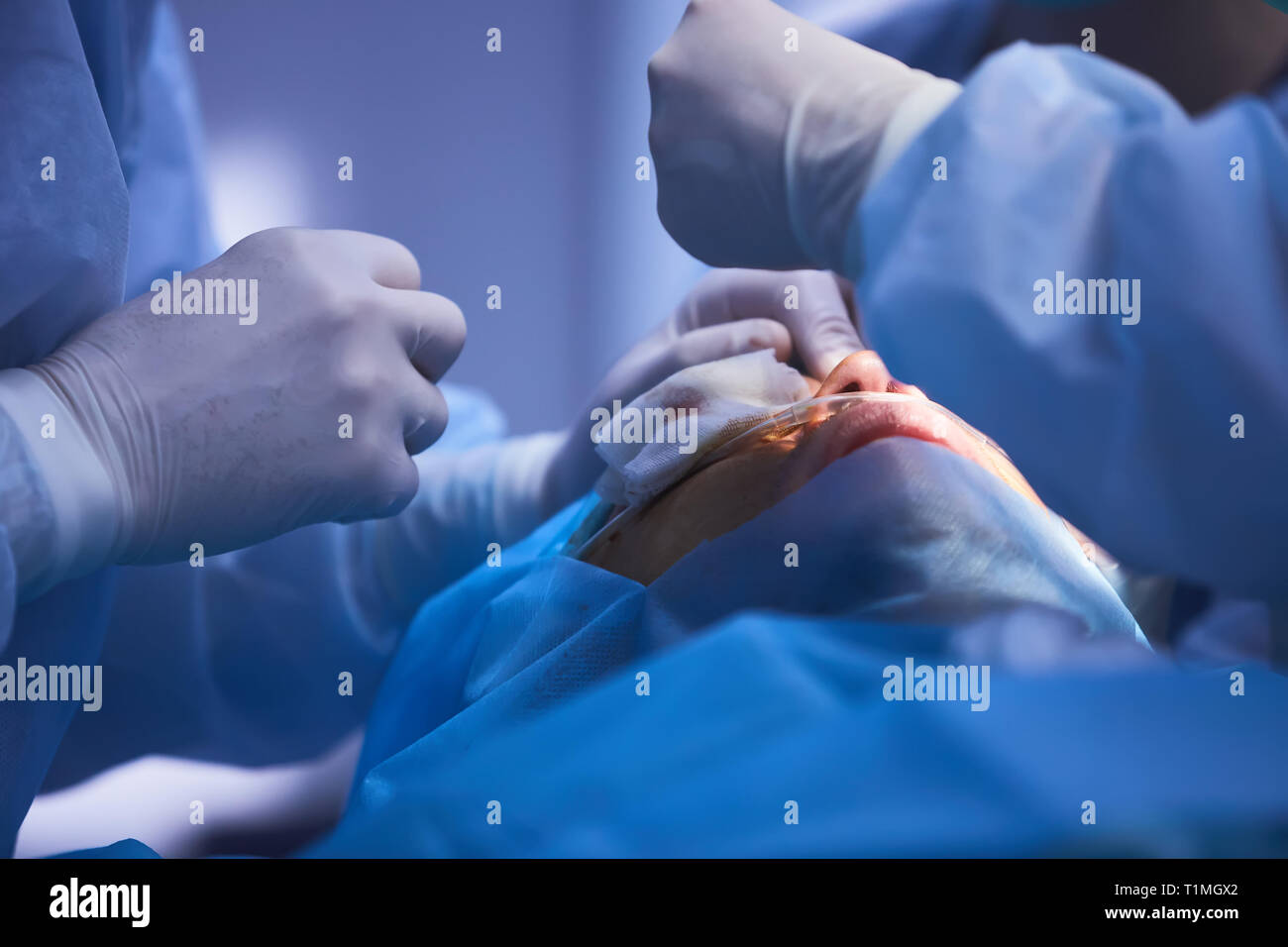 The operation on the eye. Cataract surgery Stock Photo Alamy