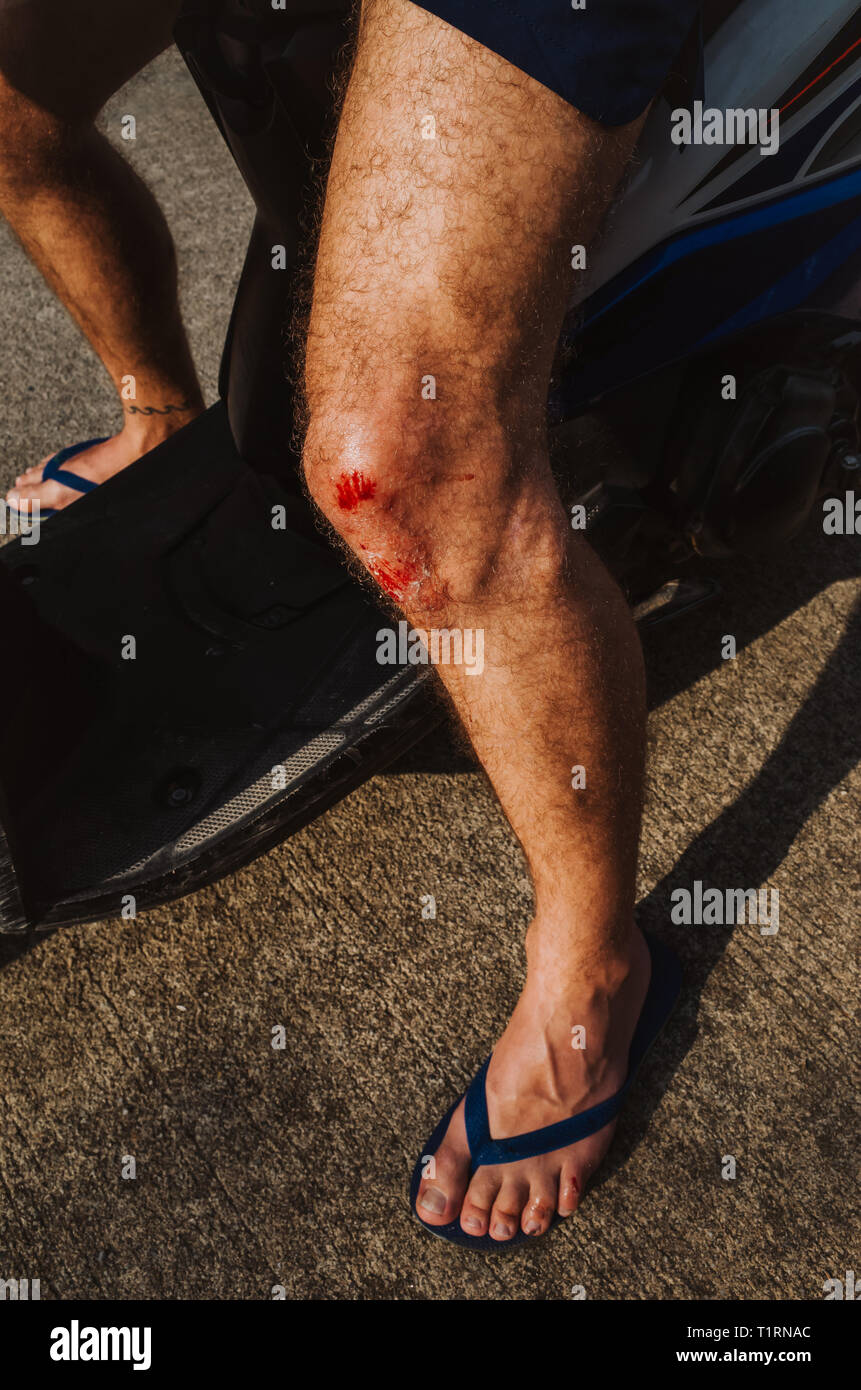Leg accident hi-res stock photography and images - Alamy