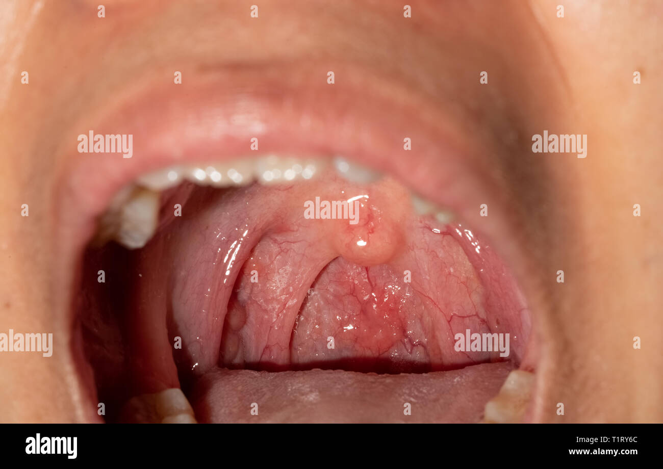 Sore throat with throat swollen. Closeup open mouth with posterior pharyngeal wall swelling and uvula and tonsil. Influenza follicles in the posterior Stock Photo