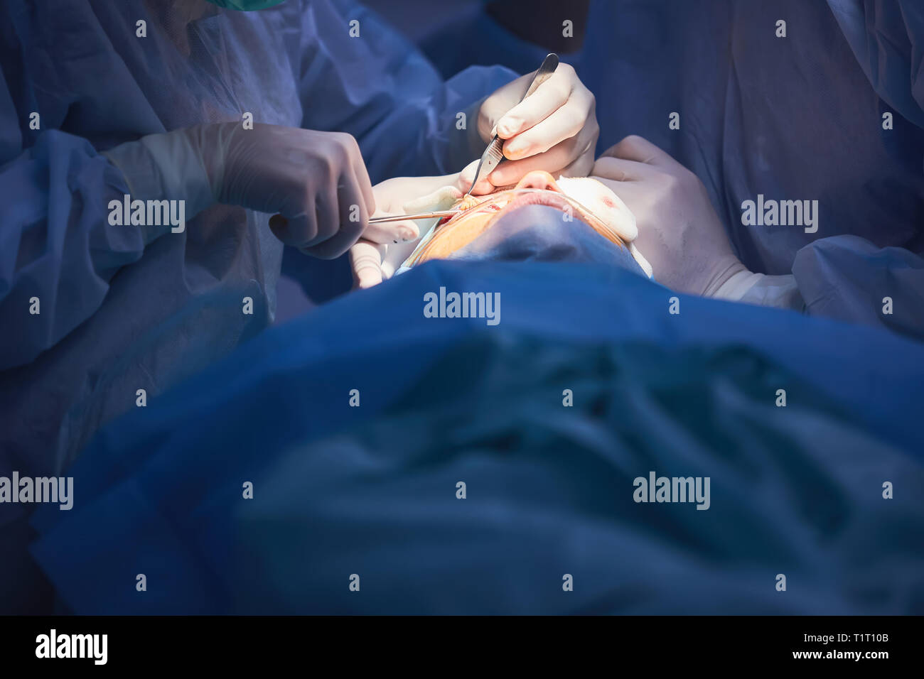 The operation on the eye. Cataract surgery Stock Photo Alamy