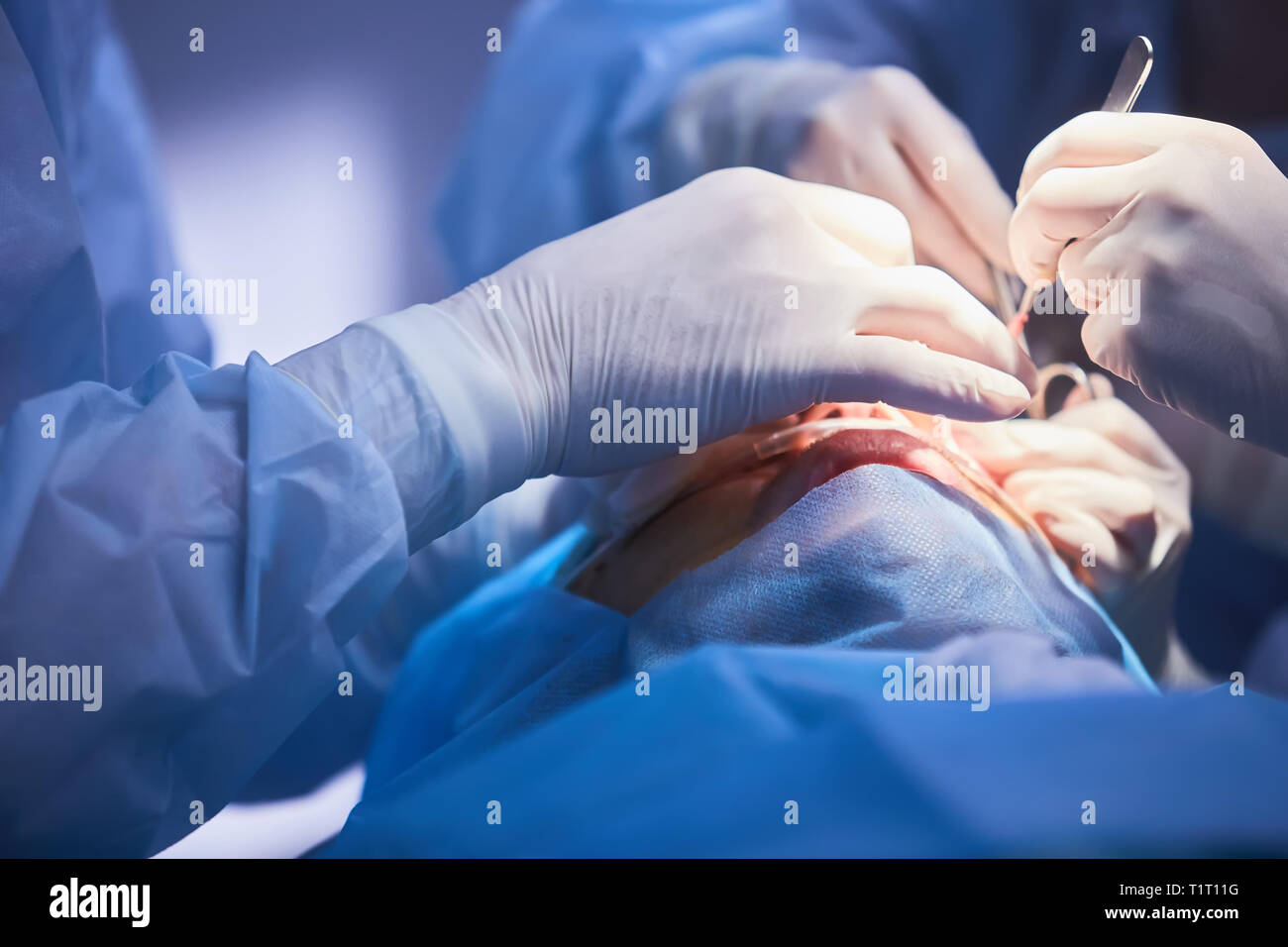 The operation on the eye. Cataract surgery Stock Photo Alamy