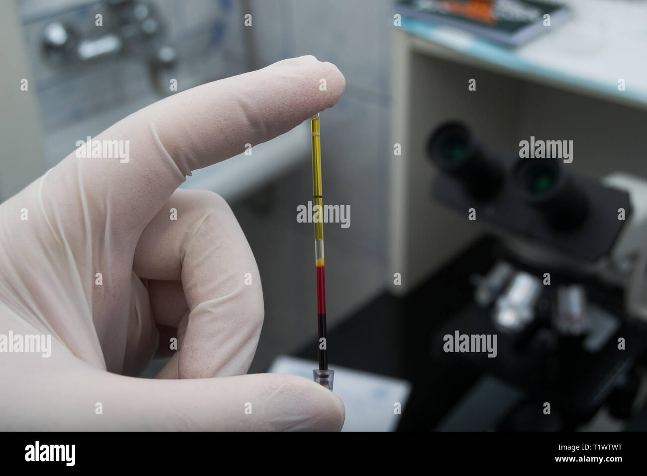 scientist holding in his hand a centrifuged blood sample with hemolysis