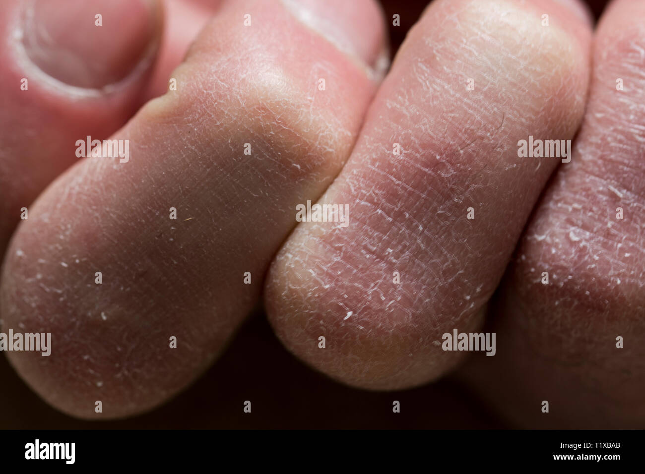 toe knuckle dry skin