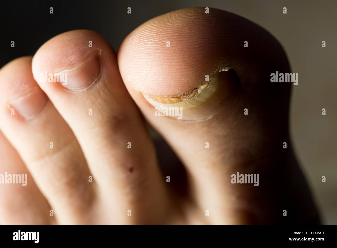 Toenails close up. Feet with toenail damage and trauma up close. Foot injury. Bacterial fungal infection. Stock Photo