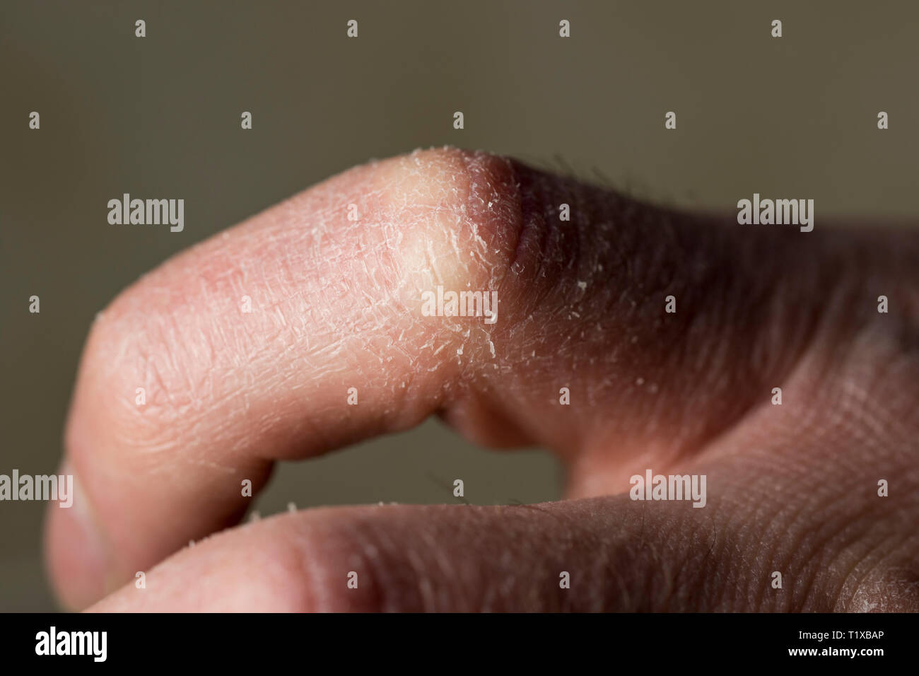 Finger With Dry Skin Damage Close Up Painful Dry Skin Pain From Not Moisturizing Itchy Cracking Dry Skin Close Up Stock Photo Alamy