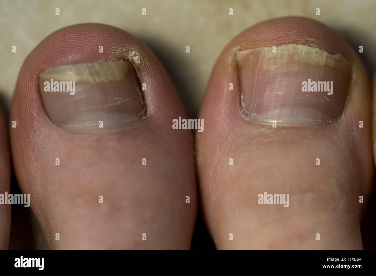 Big toenails close up with damage from shoes. Foot health and wellness treatment. Stock Photo