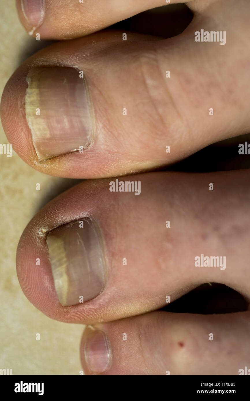 Bruised toe hires stock photography and images Alamy