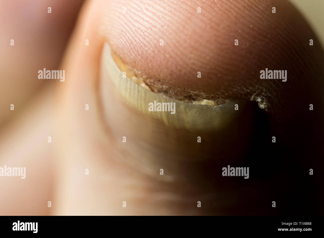 Toenail injury and bacterial fungal infection close up. Nail matrix
