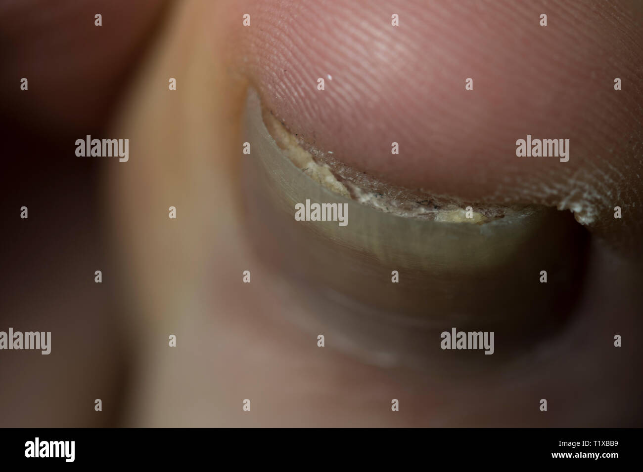 Cracked Toe High Resolution Stock Photography and Images Alamy