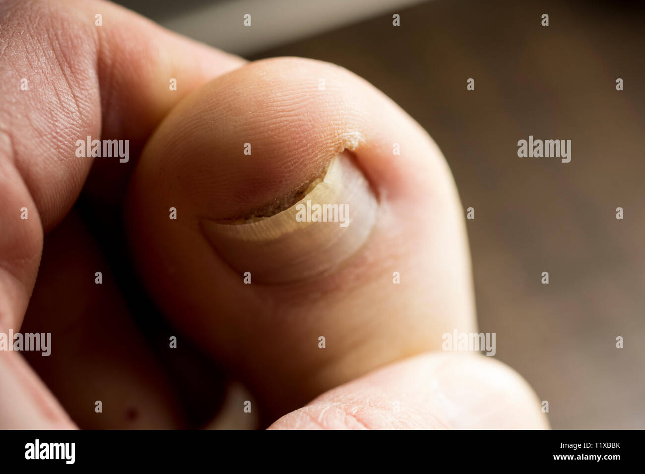 Toenail damage close up. Fallen off toenail growing back. Toenail