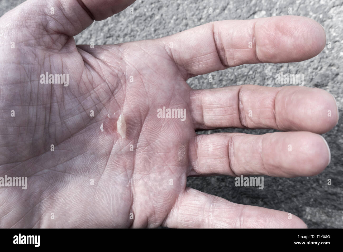 Blister On Palm Of Hand Stock Photo Alamy Blister On Palm Of Hand Stock Photo Alamy