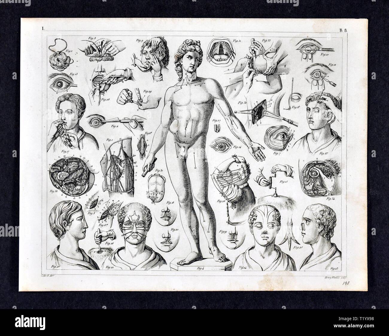 1849 Medical Illustration of various 19th century Surgical Techniques and Procedures Stock Photo